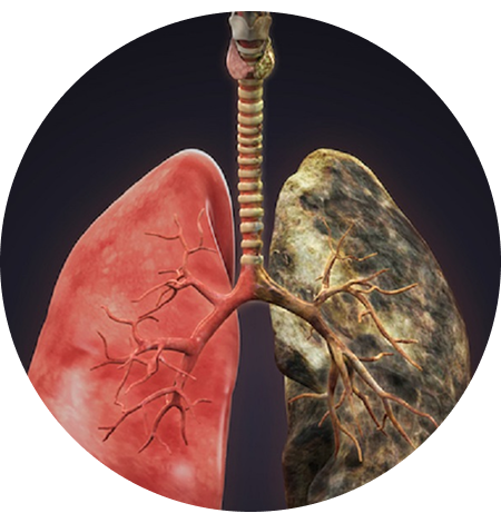 Advanced Lung Cancer Diagnosis & Treatment